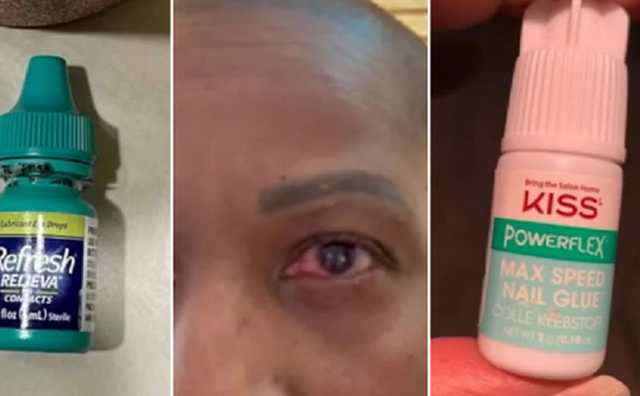 Nhỏ mắt hay dán mắt? Câu chuyện 'nhọ' của bà mẹ cầm nhầm lọ keo.