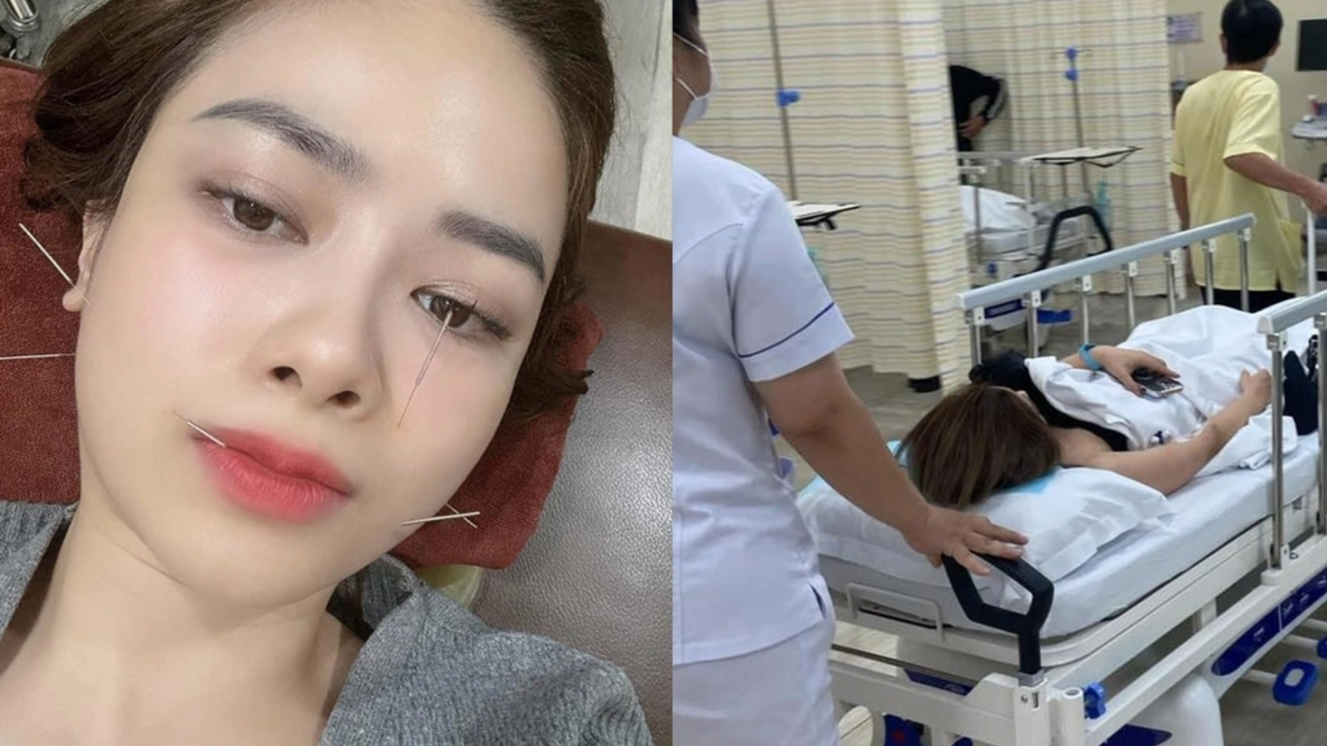 Ca sĩ Dương Hoàng Yến bị lệch mặt, liệt dây thần kinh số 7 phải cấp cứu nửa đêm